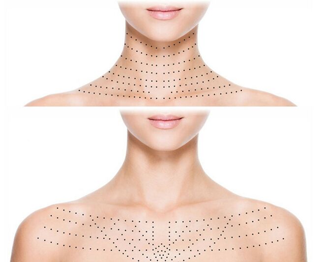 Markering op de huid van nek en decolleté voor verjongende biorevitalisatie