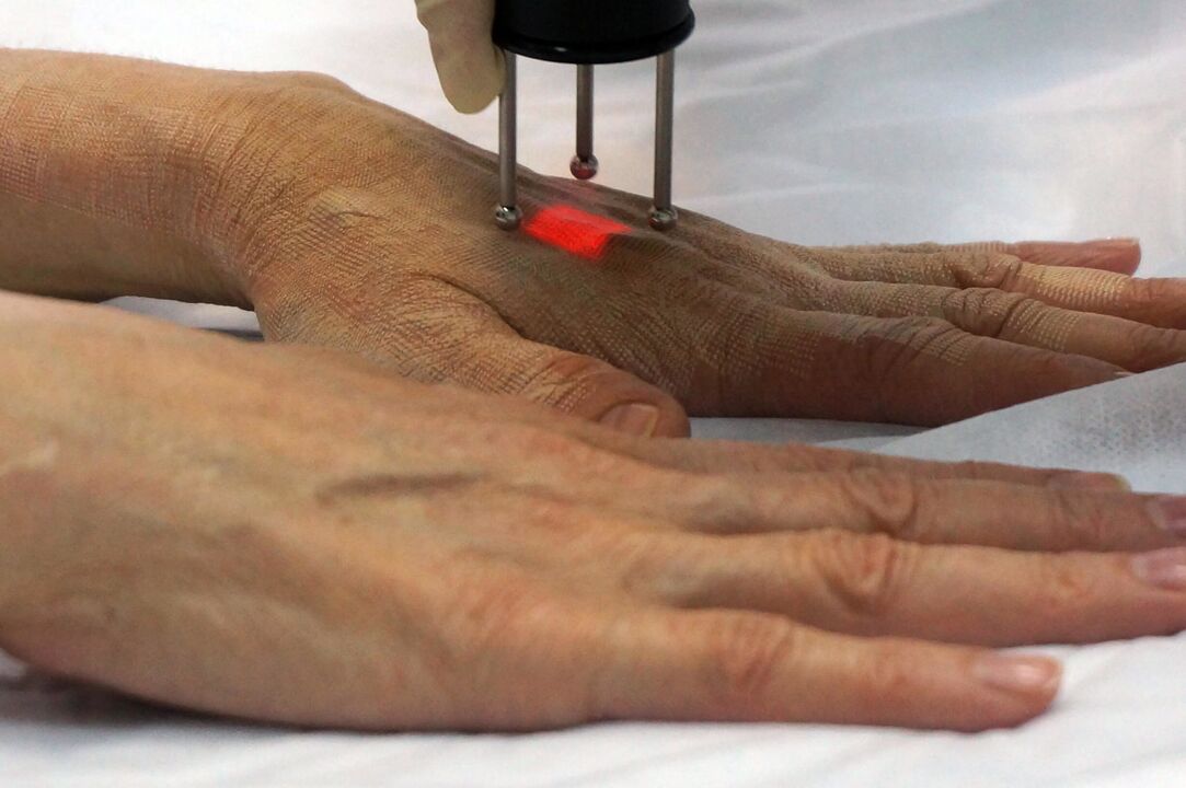 Laserverjonging van de handen met een niet-ablatieve methode