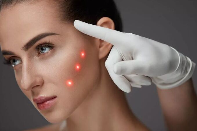 Laser verjonging van de huid
